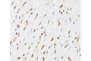 Immunohistochemistry of paraffin-embedded Human gastric cancer using RUVBL1 Polyclonal Antibody at dilution of 1:100 (40x lens). (RUVBL1 Antikörper)