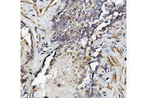 IHC analysis of MMP2 using anti-MMP2 antibody (ABIN7601677). (MMP2 Antikörper  (AA 411-660))