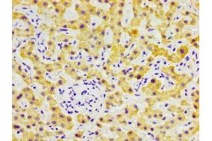 IHC image of ABIN7152767 diluted at 1:300 and staining in paraffin-embedded human liver cancer performed on a Leica BondTM system. (FGL1 Antikörper  (AA 179-282))