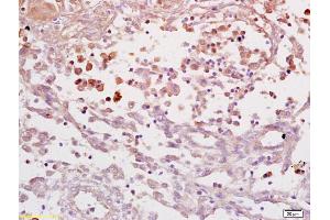 Formalin-fixed and paraffin embedded human endometrial carcinoma labeled with Anti IL-6R alpha/IL-6 receptor ? (IL6RA Antikörper  (AA 351-460))