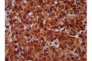 IHC image of ABIN7151929 diluted at 1:400 and staining in paraffin-embedded human glioma performed on a Leica BondTM system. (EMP2 Antikörper  (AA 22-66))