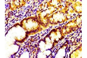 Immunohistochemistry of paraffin-embedded human gastric cancer using ABIN7156813 at dilution of 1:100 (IL17D Antikörper  (AA 16-202))
