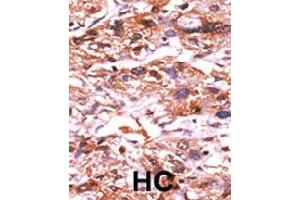 Formalin-fixed and paraffin-embedded human hepatocellular carcinoma tissue reacted with CDC25A (phospho S124) polyclonal antibody  which was peroxidase-conjugated to the secondary antibody followed by AEC staining.