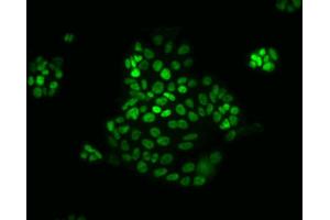 Immunofluorescent staining of human colorectal adenocarcinoma. (CDX2 Antikörper)