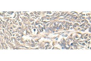 Immunohistochemistry of paraffin-embedded Human lung cancer tissue using DMC1 Polyclonal Antibody at dilution of 1:30(x200) (DMC1 Antikörper)