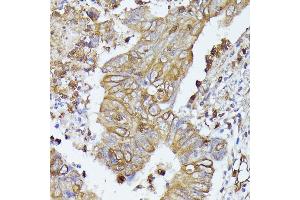 Immunohistochemistry of paraffin-embedded human colon carcinoma using CD52 antibody (ABIN7266207) at dilution of 1:100 (40x lens). (CD52 Antikörper  (AA 1-61))