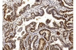 Immunohistochemical analysis of paraffin-embedded Human Ovarian cancer section using Pink1 (ABIN1882273 and ABIN2838445). (PCNA Antikörper  (C-Term))