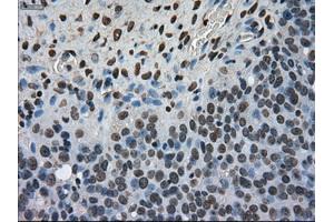 Immunohistochemical staining of paraffin-embedded Adenocarcinoma of colon tissue using anti-MKI67mouse monoclonal antibody. (Ki-67 Antikörper  (AA 1-250))