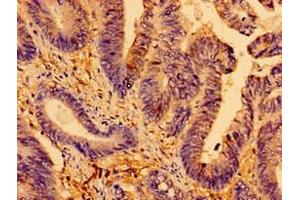 Immunohistochemistry of paraffin-embedded human colon cancer using ABIN7144021 at dilution of 1:100 (AMPD2 Antikörper  (AA 1-129))