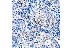 Immunohistochemistry of paraffin-embedded human cervix cancer using IL22 Rabbit pAb (ABIN6128134, ABIN6142363, ABIN6142364 and ABIN6221808) at dilution of 1:1000 (40x lens). (IL-22 Antikörper  (AA 34-179))