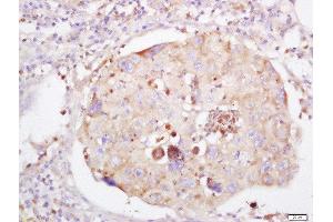 Formalin-fixed and paraffin embedded human lung carcinoma labeled with Anti-LRRC25 Polyclonal Antibody, Unconjugated  at 1:200 followed by conjugation to the secondary antibody and DAB staining (LRRC25 Antikörper  (AA 81-180))