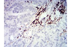 Immunohistochemical analysis of paraffin-embedded rectum cancer tissues using CD45 mouse mAb with DAB staining. (CD45 Antikörper  (AA 431-577))