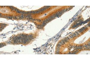 Immunohistochemistry of paraffin-embedded Human colon cancer tissue using CIB1 Polyclonal Antibody at dilution 1:30 (CIB1 Antikörper)