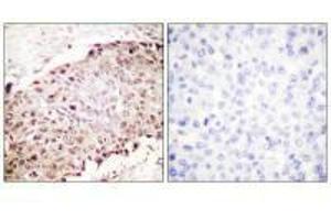 Immunohistochemistry analysis of paraffin-embedded human breast carcinoma tissue using Sumo1 antibody. (SUMO1 Antikörper  (N-Term))