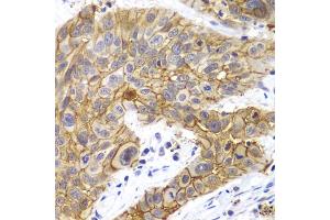 Immunohistochemistry of paraffin-embedded human lung cancer using CLDN1 antibody. (Claudin 1 Antikörper)