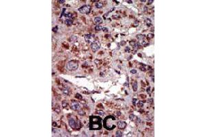 Formalin-fixed and paraffin-embedded human cancer tissue reacted with DGKA polyclonal antibody  , which was peroxidase-conjugated to the secondary antibody, followed by AEC staining. (DGKA Antikörper  (C-Term))