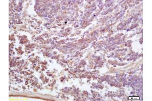 Formalin-fixed and paraffin embedded human lung carcinoma labeled with Anti-ADAM19 Polyclonal Antibody, Unconjugated (ABIN758801) at 1:200 followed by conjugation to the secondary antibody and DAB staining