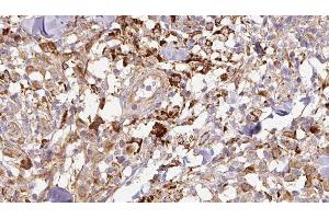 ABIN6276882 at 1/100 staining Human Melanoma tissue by IHC-P. (TFF1 Antikörper  (Internal Region))