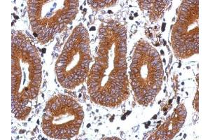 IHC-P Image Immunohistochemical analysis of paraffin-embedded human colon carcinoma, using Tetraspan 1, antibody at 1:500 dilution.