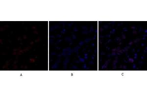 Immunofluorescence analysis of human breast cancer tissue. (DNMT3B Antikörper  (AA 1-80))