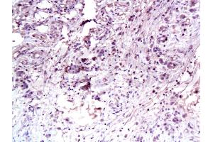 Formalin-fixed and paraffin embedded human gastric carcinoma labeled Anti-C-Met Polyclonal Antibody, Unconjugated (ABIN671661) at 1:100, followed by conjugation to the secondary antibody and DAB staining (c-MET Antikörper  (AA 25-150))