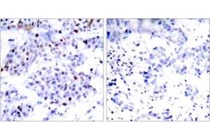 Immunohistochemistry analysis of paraffin-embedded human breast carcinoma tissue, using STAT6 (Ab-645) Antibody. (STAT6 Antikörper  (AA 612-661))