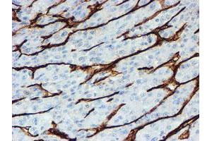 Immunohistochemical staining of paraffin-embedded Carcinoma of Human liver tissue using anti-PECAM1 mouse monoclonal antibody. (CD31 Antikörper)