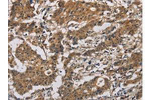 The image is immunohistochemistry of paraffin-embedded Human gastric cancer tissue using ABIN7128636(BCL2L12 Antibody) at dilution 1/20. (BCL2L12 Antikörper)