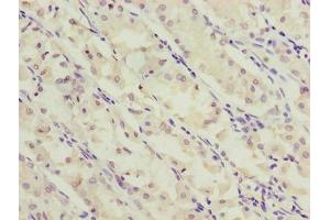 Immunohistochemistry of paraffin-embedded human gastric cancer using ABIN7170275 at dilution of 1:100 (GPR172A Antikörper  (AA 217-276))