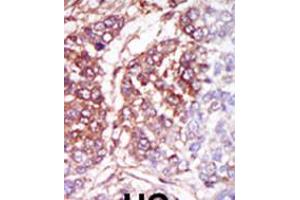 Formalin-fixed and paraffin-embedded human cancer tissue reacted with the primary antibody, which was peroxidase-conjugated to the secondary antibody, followed by DAB staining. (CSNK1G3 Antikörper  (C-Term))