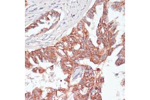 Immunohistochemistry of paraffin-embedded human lung cancer using TI antibody (ABIN6130725, ABIN6149146, ABIN6149147 and ABIN6214431) at dilution of 1:100 (40x lens). (TIAM1 Antikörper  (AA 1392-1591))