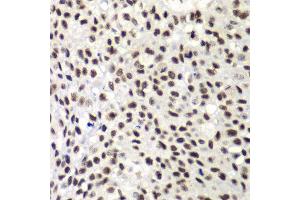 Immunohistochemistry of paraffin-embedded human lung cancer using NELFE antibody at dilution of 1:100 (x40 lens). (RDBP Antikörper)