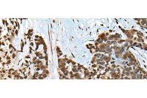 Immunohistochemistry of paraffin-embedded Human thyroid cancer tissue using CCDC12 Polyclonal Antibody at dilution of 1:60(x200)