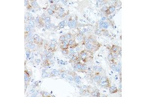 Immunohistochemistry of paraffin-embedded human liver cancer using TFR2 antibody (ABIN6128863, ABIN6149063, ABIN6149064 and ABIN6225172) at dilution of 1:100 (40x lens). (Transferrin Receptor 2 Antikörper  (AA 582-801))