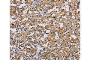 Immunohistochemistry of Human thyroid cancer using GPM6A Polyclonal Antibody at dilution of 1:50 (GPM6A Antikörper)