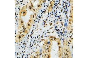 Immunohistochemical analysis of PRPF39 staining in human lung cancer formalin fixed paraffin embedded tissue section. (PRPF39 Antikörper)