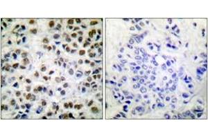 Immunohistochemistry analysis of paraffin-embedded human breast carcinoma, using POLR2A (Phospho-Ser1619) Antibody. (POLR2A/RPB1 Antikörper  (pSer1619))