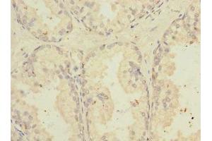Immunohistochemistry of paraffin-embedded human prostate cancer using ABIN7173811 at dilution of 1:100 (TNFSF15 Antikörper  (AA 72-251))