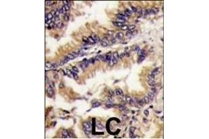 Forlin-fixed and paraffin-embedded hun lung carcino tissue reacted with PK1 Antibody (Center) (ABIN391367 and ABIN2841384) , which was peroxidase-conjugated to the secondary antibody, followed by DAB staining. (ERK2 Antikörper  (AA 154-183))