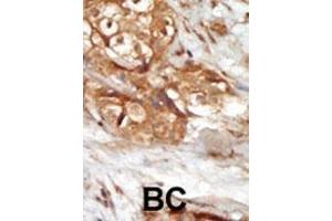 Formalin-fixed and paraffin-embedded human cancer tissue reacted with the primary antibody, which was peroxidase-conjugated to the secondary antibody, followed by AEC staining. (MAP3K14 Antikörper  (AA 119-148))