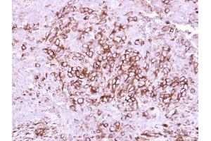 IHC-P Image Immunohistochemical analysis of paraffin-embedded human breast cancer, using CD40, antibody at 1:250 dilution. (CD40 Antikörper  (Center))