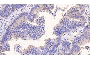 Detection of PIIINP in Human Colorectal cancer Tissue using Monoclonal Antibody to Procollagen III N-Terminal Propeptide (PIIINP) (PIIINP Antikörper)