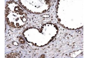 IHC-P Image UBE3A antibody detects UBE3A protein at nucleus on human ovarian carcinoma by immunohistochemical analysis. (ube3a Antikörper)