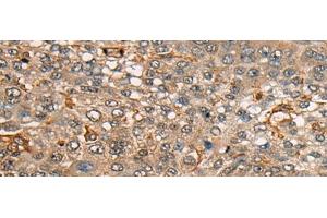Immunohistochemistry of paraffin-embedded Human liver cancer tissue using CDT1 Polyclonal Antibody at dilution of 1:45(x200) (CDT1 Antikörper)
