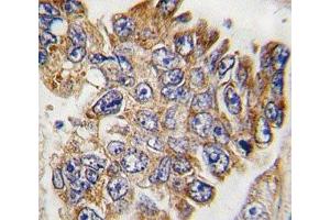 IHC analysis of FFPE human lung carcinoma tissue stained with GRB2 antibody (GRB2 Antikörper  (AA 187-216))