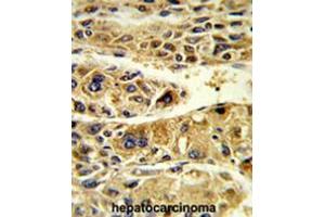 Formalin-fixed and paraffin-embedded human hepatocarcinoma reacted with ADH6 Antibody (Center), which was peroxidase-conjugated to the secondary antibody, followed by DAB staining.