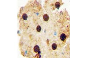 Immunohistochemistry analysis in formalin fixed and paraffin embedded human skin carcinoma reacted with OAZ2 Antibody (C-term) followed by peroxidase conjugation of the secondary antibody and DAB staining. (OAZ2 Antikörper  (C-Term))