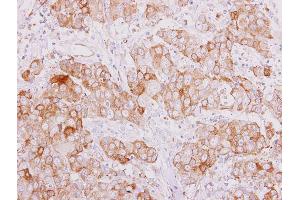 IHC-P Image SMAD9 antibody detects SMAD9 protein at cytoplasm on human breast carcinoma by immunohistochemical analysis. (SMAD9 Antikörper)