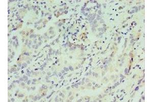 Immunohistochemistry of paraffin-embedded human lung cancer using ABIN7148809 at dilution of 1:100 (AFT7 Antikörper  (AA 1-117))