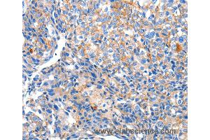 Immunohistochemistry of Human ovarian cancer using HCN2 Polyclonal Antibody at dilution of 1:80 (HCN2 Antikörper)